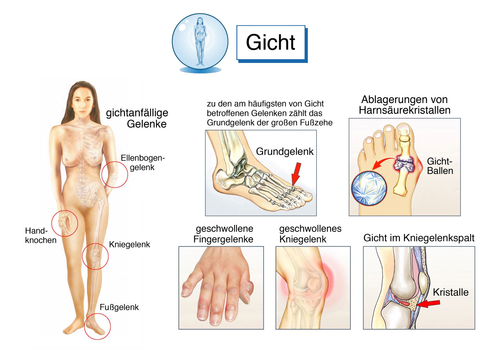 Carmen Franken: Gicht – eine „Wohlstandserkrankung“