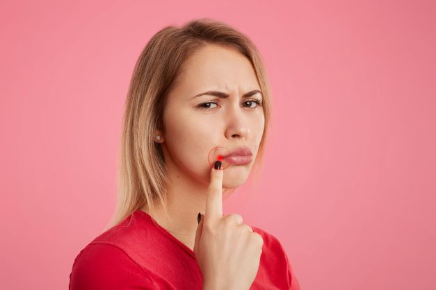 Carmen Franken: Herpes labialis – ein hässlicher Untermieter